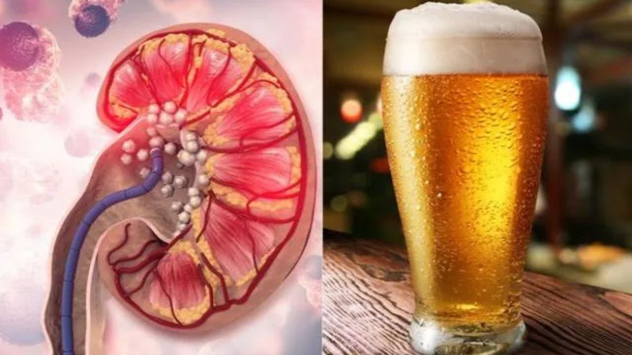 Water Intake For Kidney Stone: बीयर से पथरी ठीक होने का दावा निकला गलत. एक्सपर्ट्स ने दी गंभीर चेतावनी