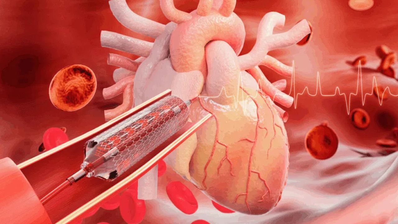 हार्ट स्टेंट की कीमत को लेकर भ्रम क्यों? इलाज से पहले जानिए जरूरी तथ्य