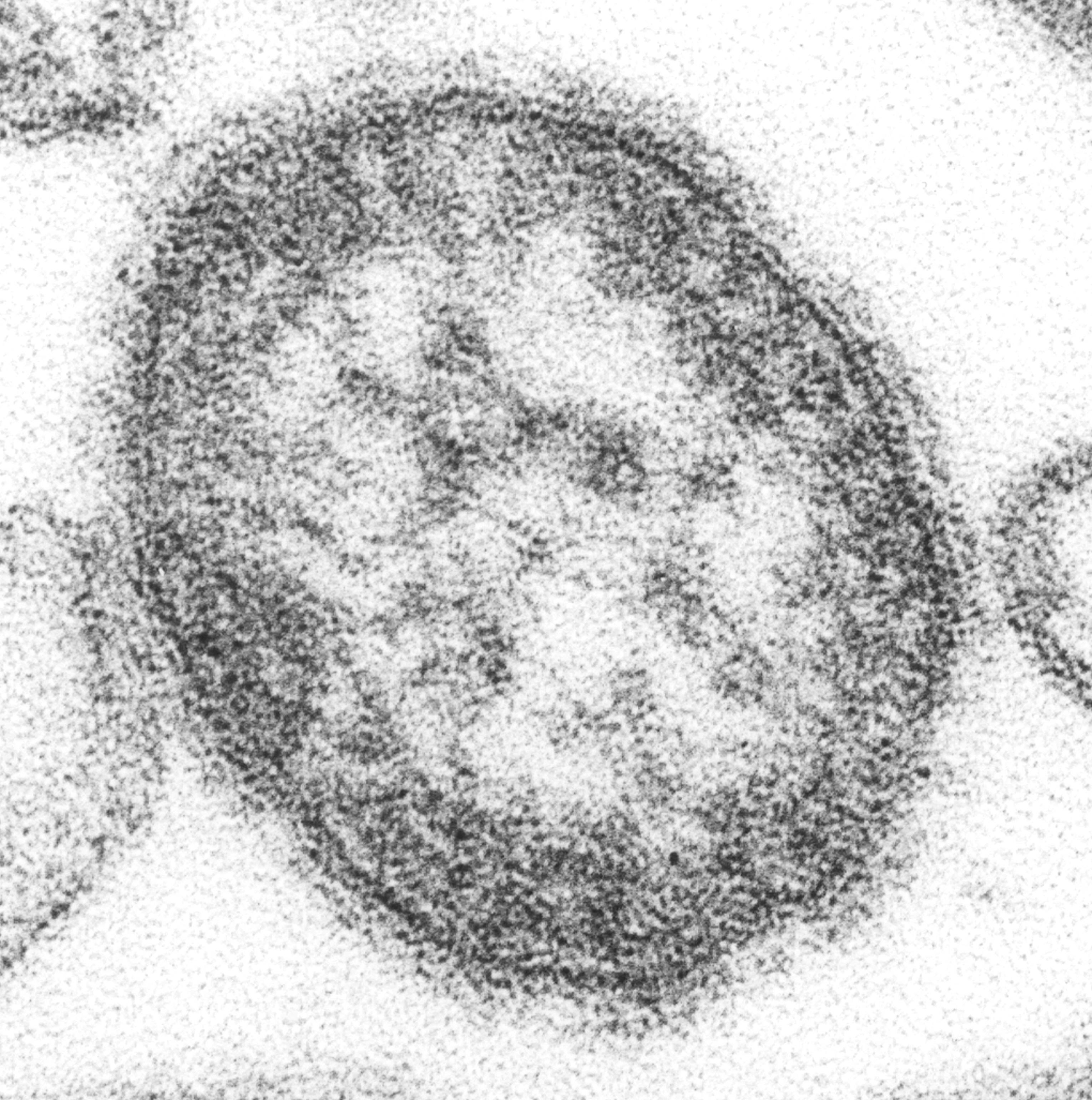 US Measles Outbreak Grows as Reported Cases Reach 4,410 - NewsNation Online