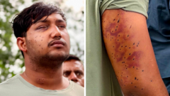 Indias cockroach protesters have wounds consistent with pellet-gun fire say experts - NewsNation Online India's 'cockroach' protesters have wounds consistent with pellet-gun fire, say experts
